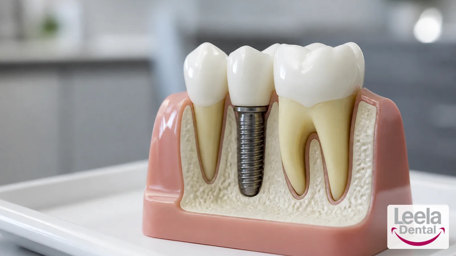 Dental implants at Leela Super Speciality Dental Hospital, Kakinada.