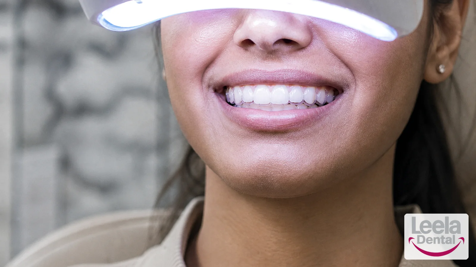 Teeth whitening at Leela Super Speciality Dental Hospital, Kakinada.